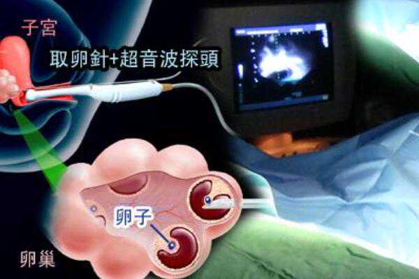 2023浙江试管婴儿医院排名,浙江省人民医院试管婴儿费用